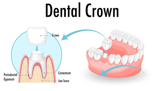 dental-cronw