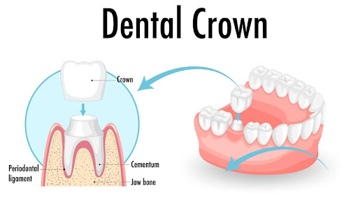 dental-cronw