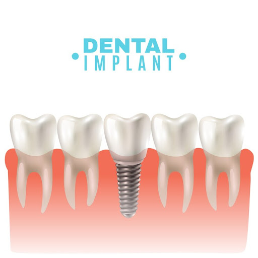 implants