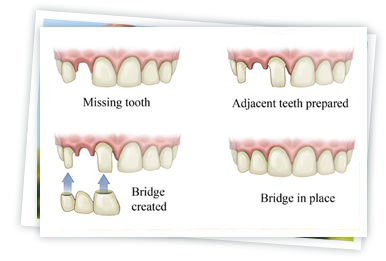 Dental Bridge Replaces The Missing Tooth