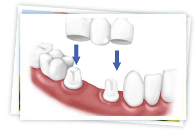 Dental Crowns