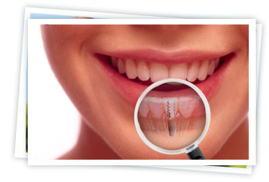 Dental Implants