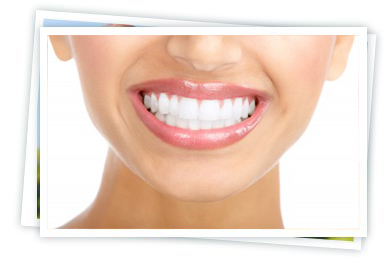 Dental Veneers