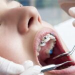 Close-up of a patient with braces during a dental checkup, dentist using mirror and tool to examine teeth and treat a cavity with a dental filling