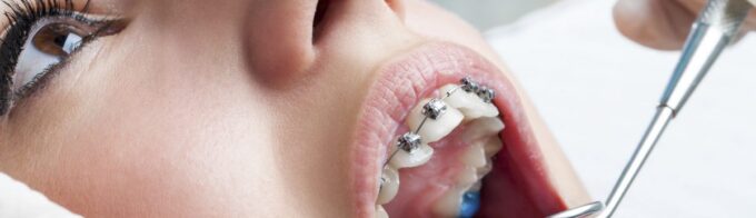 Close-up of a patient with braces during a dental checkup, dentist using mirror and tool to examine teeth and treat a cavity with a dental filling
